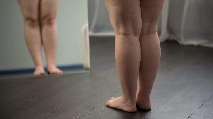 lipedema e hormônios