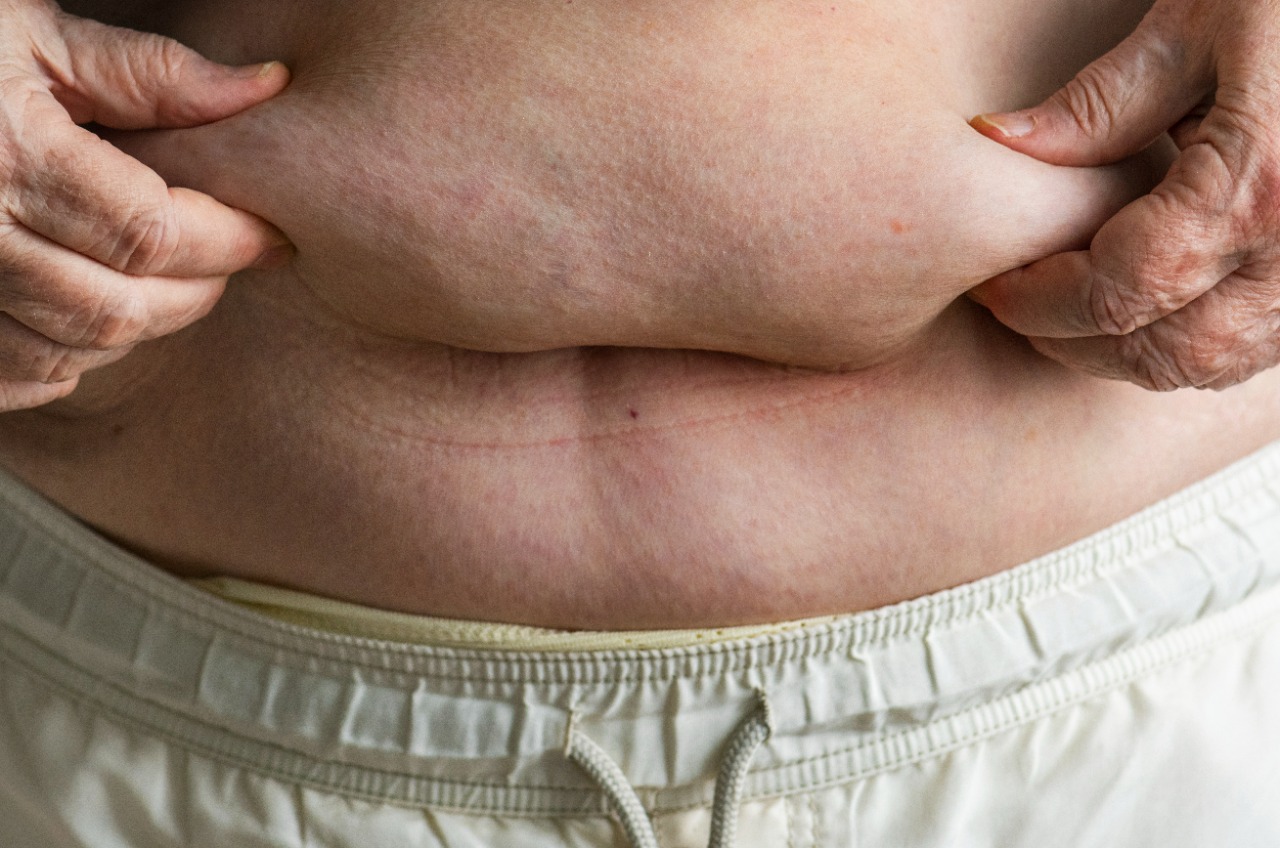 Obesidade Mórbida (Grau 3): o que é, causas e prevenção