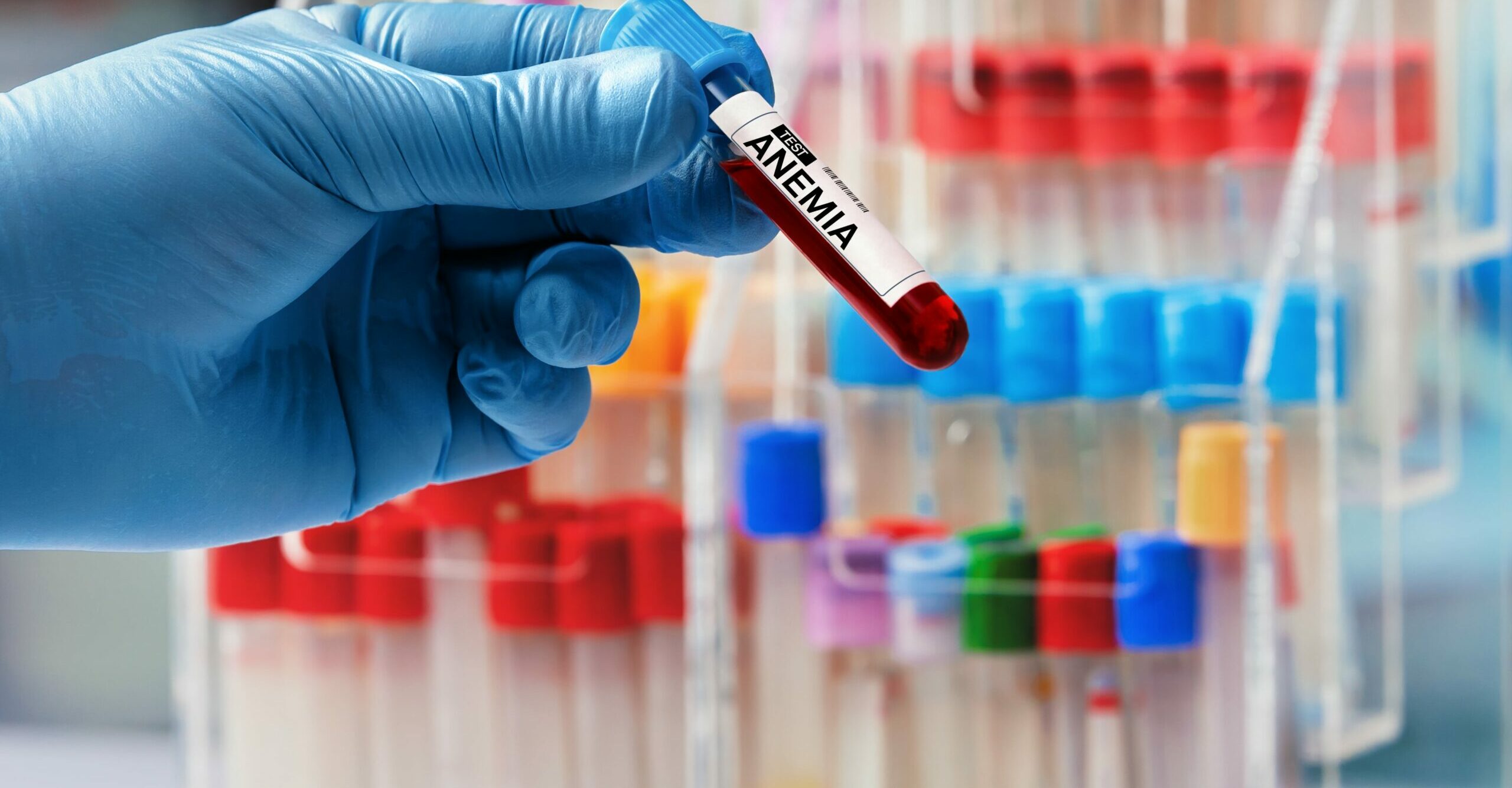 Anemia falciforme: o que é, sintomas, causas e tratamento