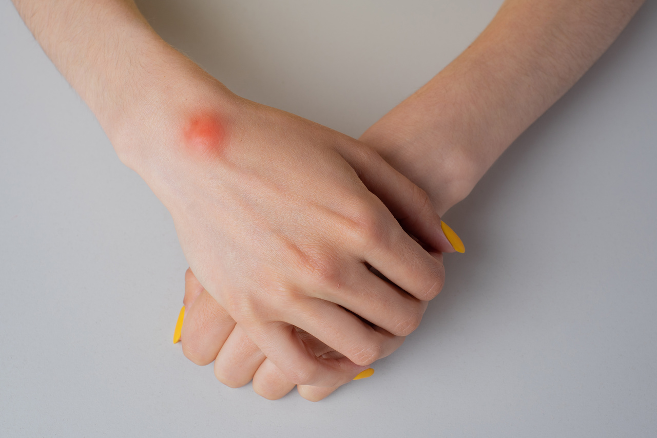 Caroços na pele: o que são, sintomas, tratamentos e causas