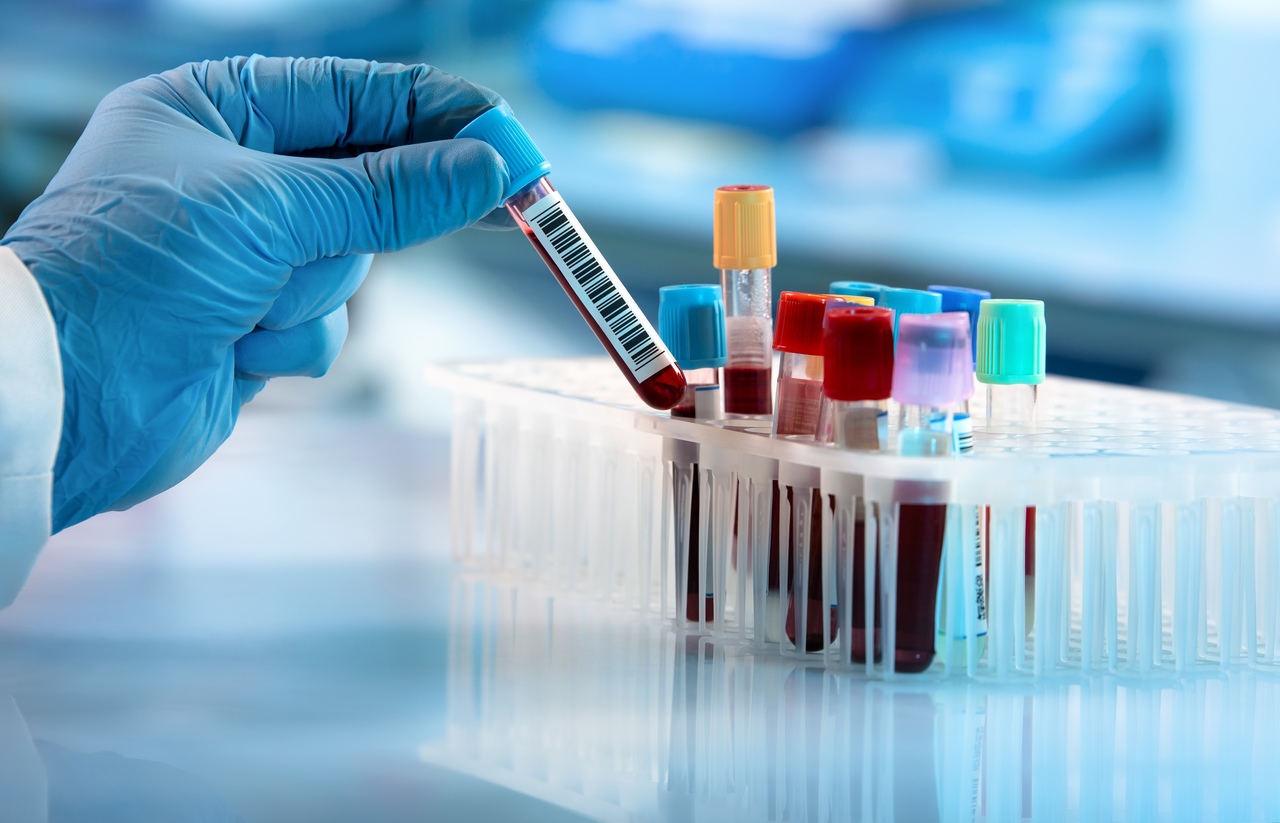 Exame adenosina deaminase – ADA: o que é e como ele é feito?